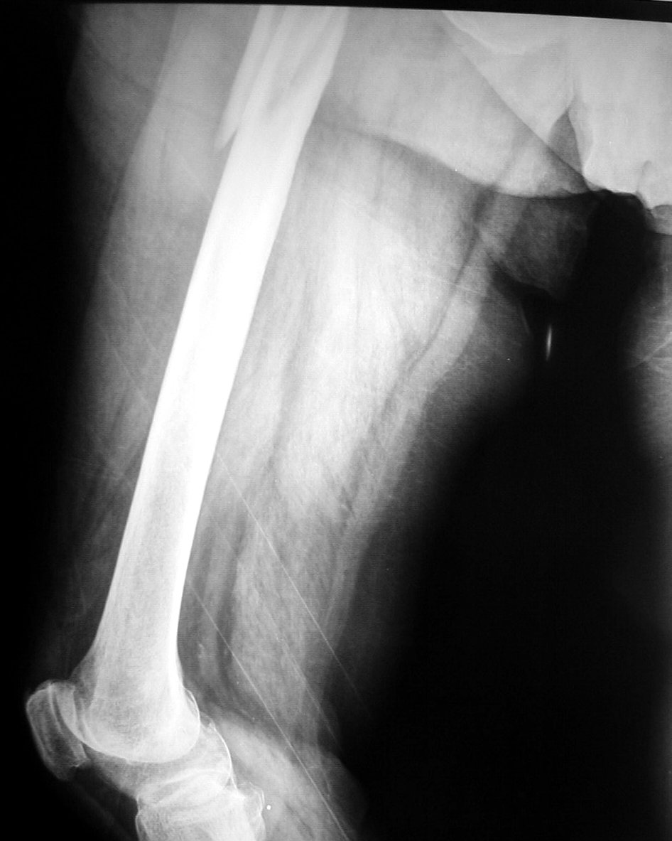 Radiografía de fractura de femur