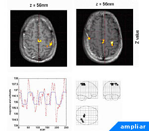 Actividad cerebral a través de la técnica de Imágen de Resonancia Magnética Funcional