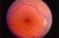 Retina a través de un oftalmoscopio